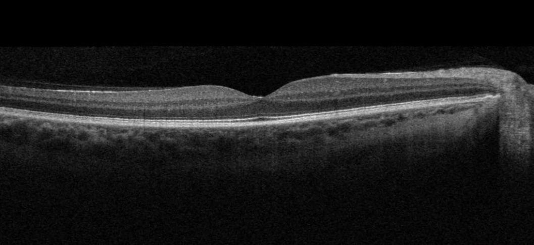 Corneal thickness measurement: Pachymetry, a practitioner’s guide