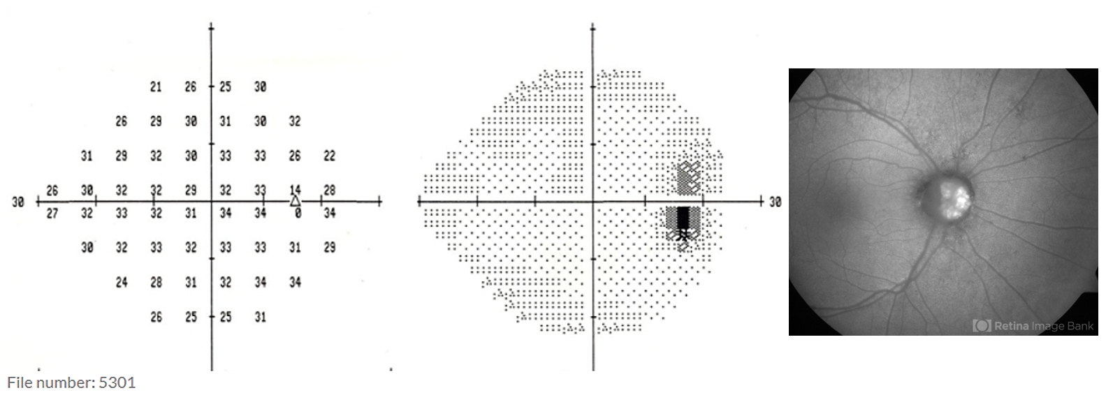 Optometry Atlas Optic nerve conditions Viewpoint