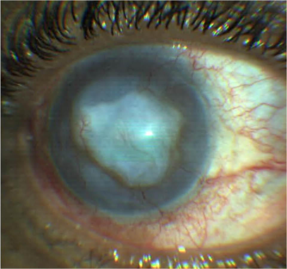 Bullous keratopathy Viewpoint