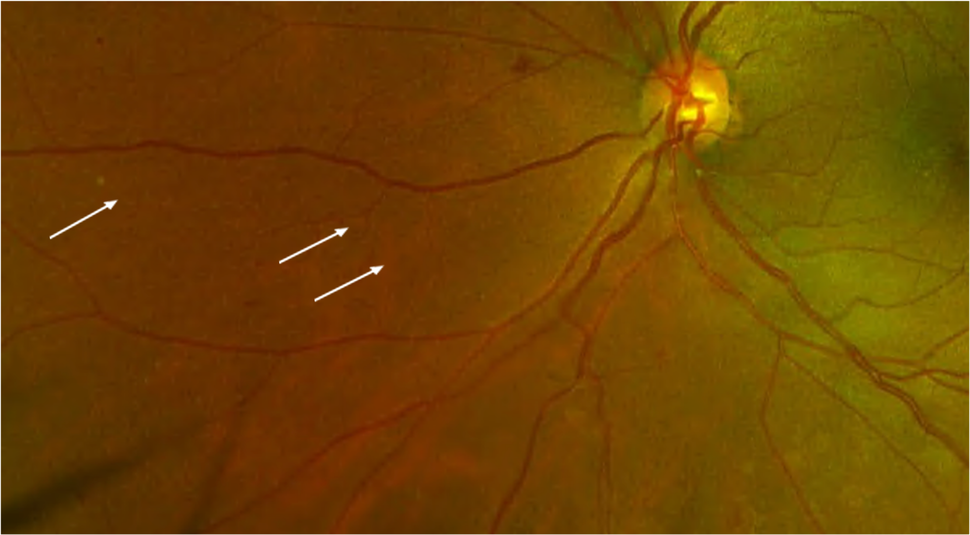 Diabetic retinopathy Viewpoint