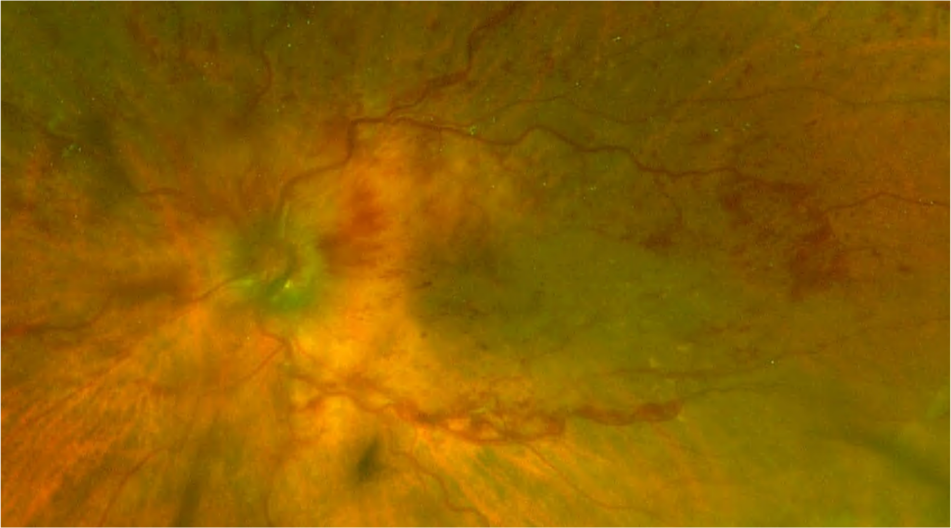 15 Retinal Occlusion Stock Photos High Res Pictures And Images