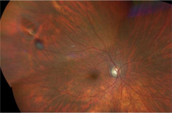 Shafer's Sign Eye