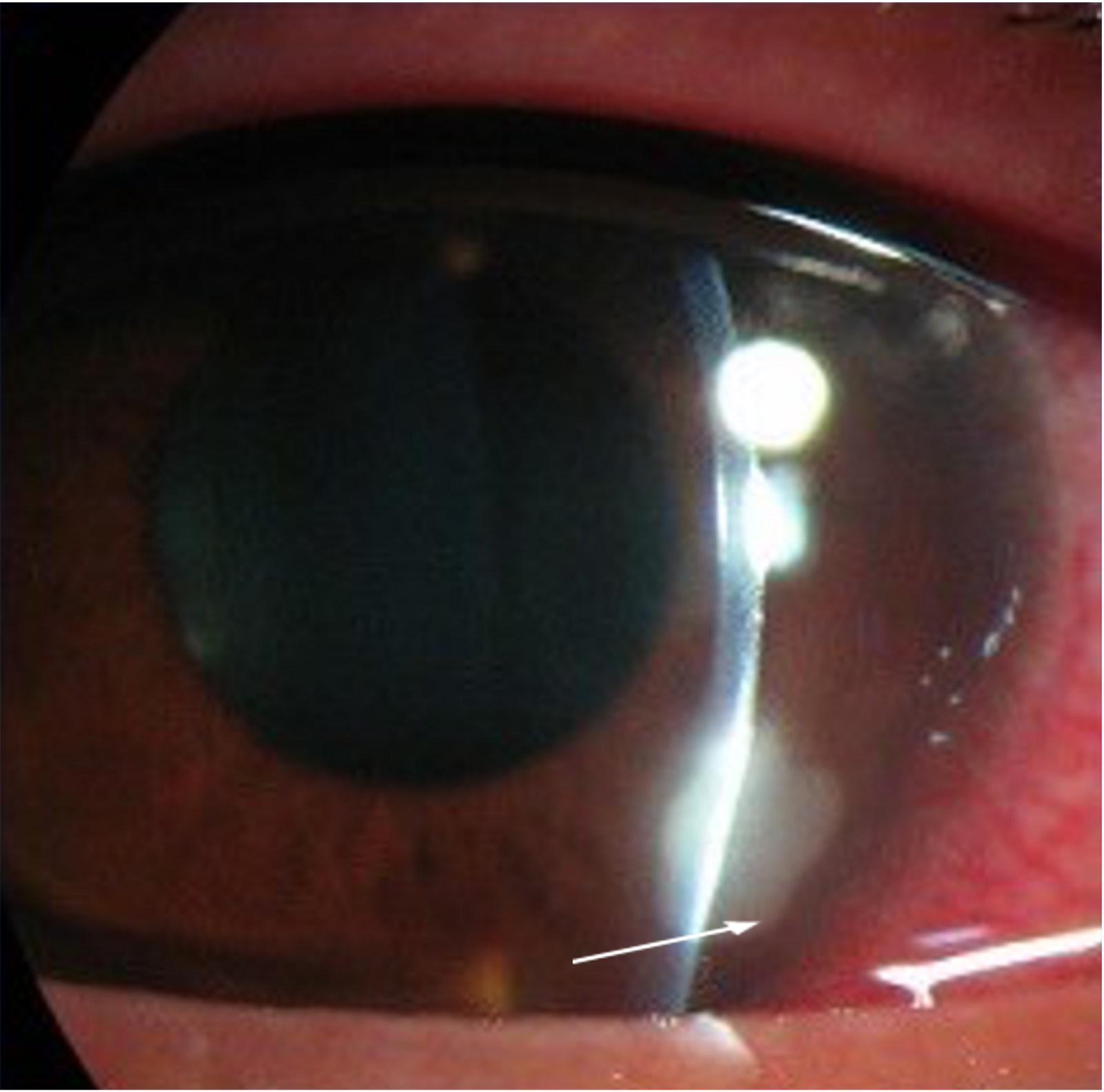 Contact lens complications | Viewpoint