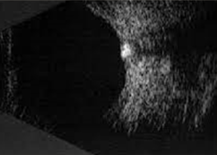 Optic disc drusen Viewpoint