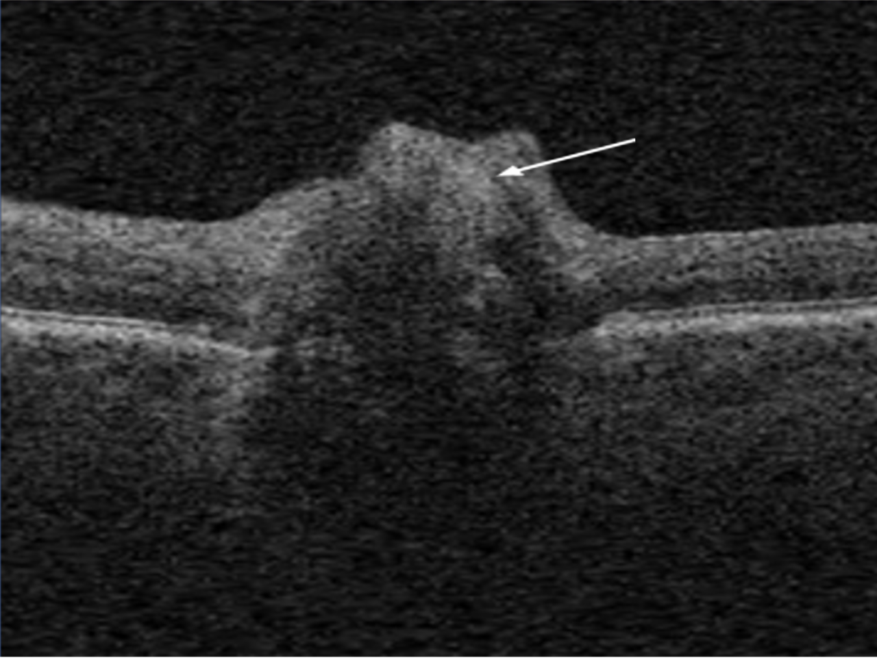 Optic disc drusen Viewpoint