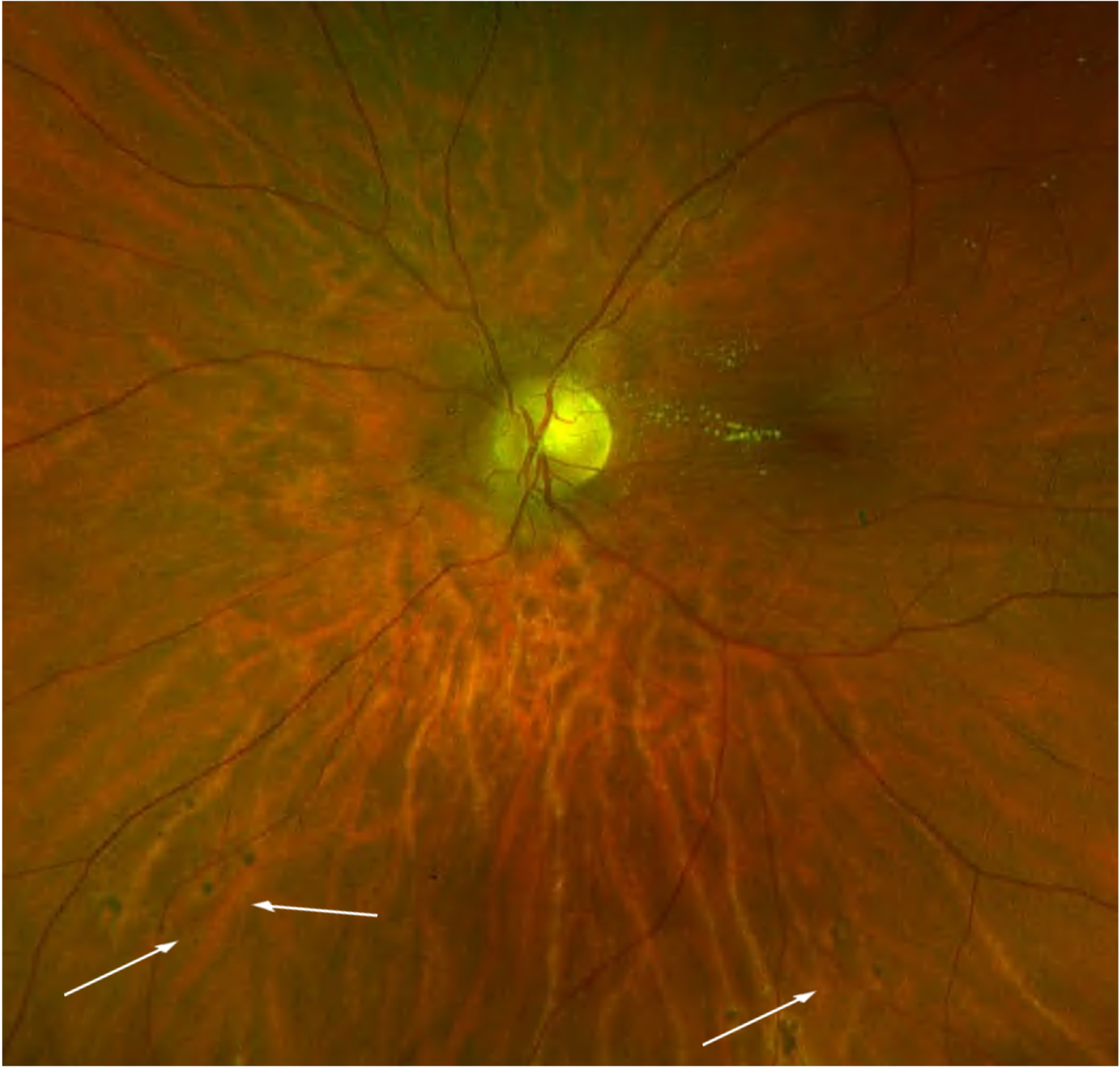 hypertensive-retinopathy-viewpoint