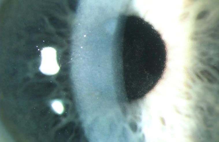 Fuchs’s endothelial corneal dystrophy – note cloudy endothelial part of the cornea along with increased corneal thickness.