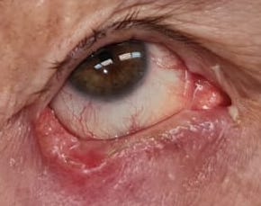The basal cell carcinoma of the right lower eyelid