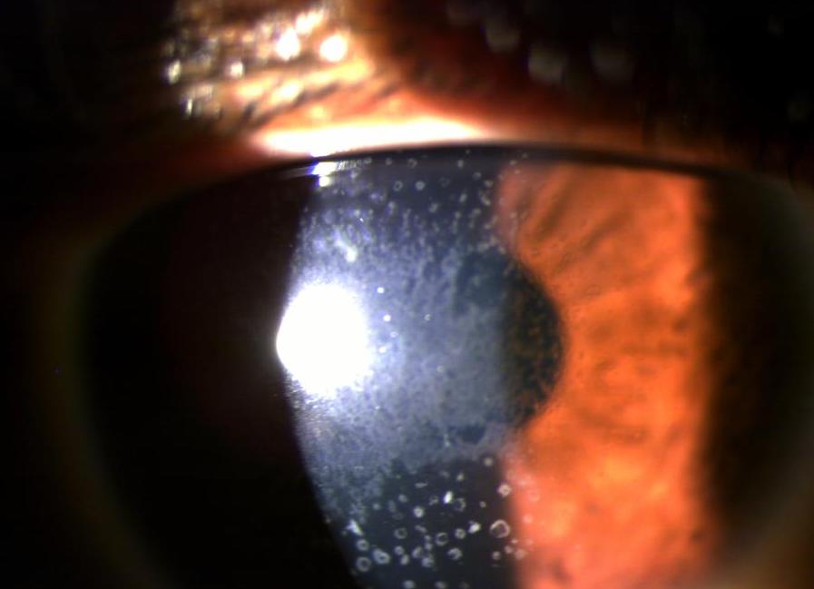 Stromal corneal dystrophy